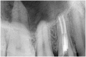 上原2　根管充填